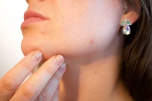 पिम्पल्स हटाने के घरेलू उपाय | Pimples treatment at home | in hindi