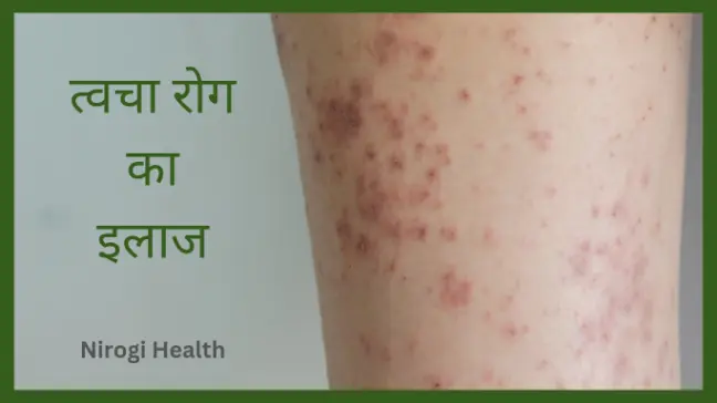 त्वचा रोग का घरेलू इलाज | Skin infection home remedies tips | in hindi