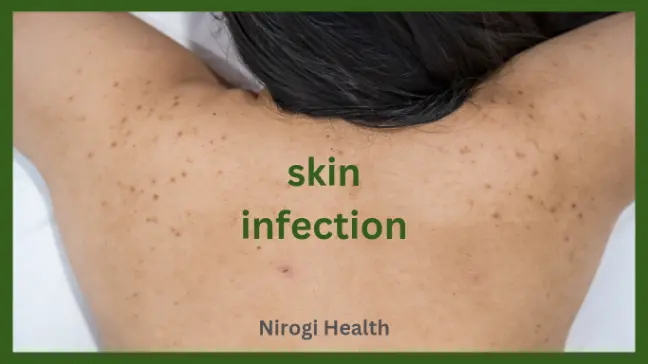 त्वचा रोग का घरेलू इलाज | Skin infection home remedies tips | in hindi