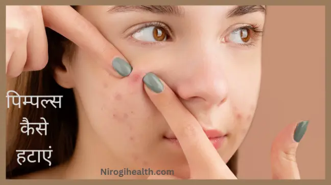 how to remove pimples naturally in hindi